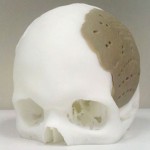 3D Printed Skull Replacement